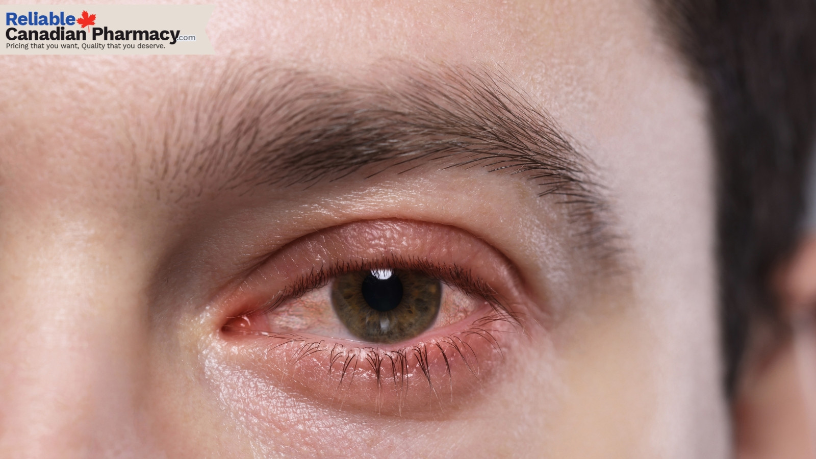 Eye infection
