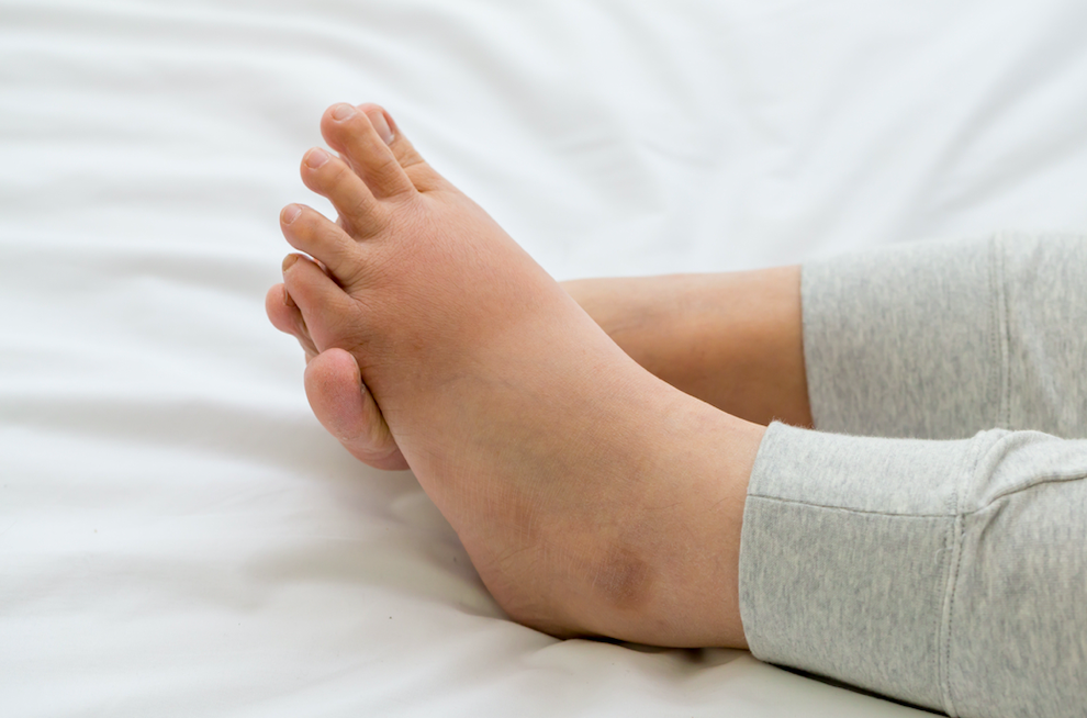 edema feet