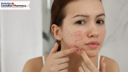 Adult Acne Treatment Guide: Choosing the Right Medication for Clearer Skin